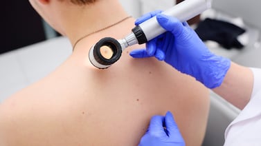 Moderna y Merck anuncian resultados positivos de una vacuna contra el cáncer de piel